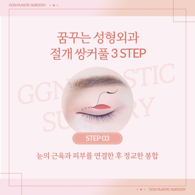 [강남 쌍꺼풀 수술]쌍꺼풀 절개법이란? 사진 5