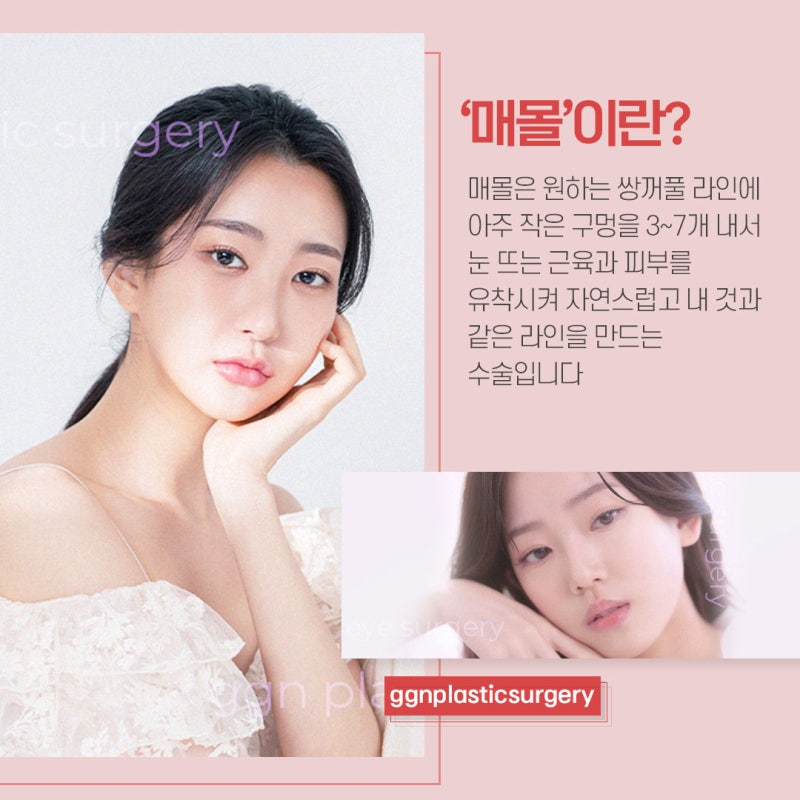 [강남 눈성형]자연유착 쌍꺼풀 매몰법의 모든것! 사진 2