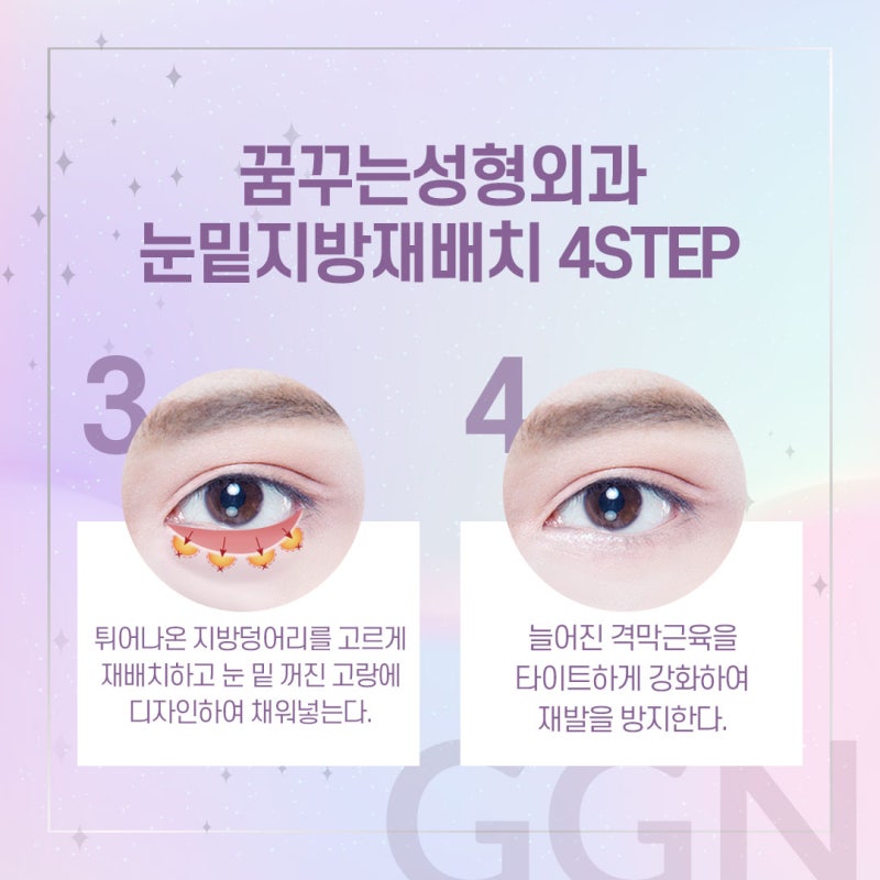 [강남 눈밑지방재배치] 다크서클이 고민이 되세요? 사진 6