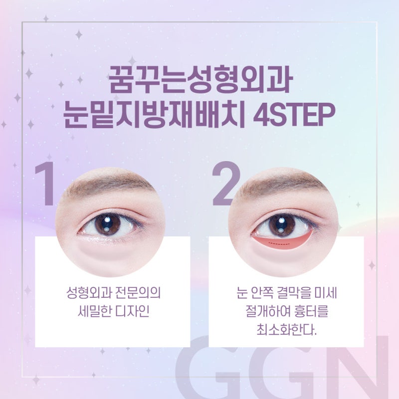 [강남 눈밑지방재배치] 다크서클이 고민이 되세요? 사진 5