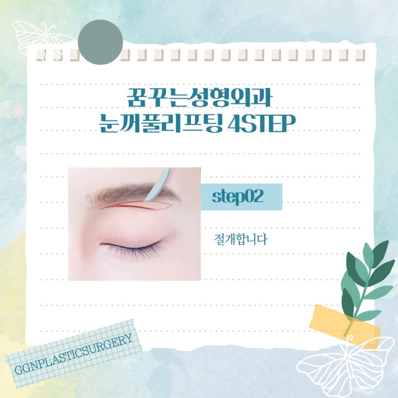 [강남 눈성형] 눈꺼풀 리프팅 비법 알려드립니다 사진 5