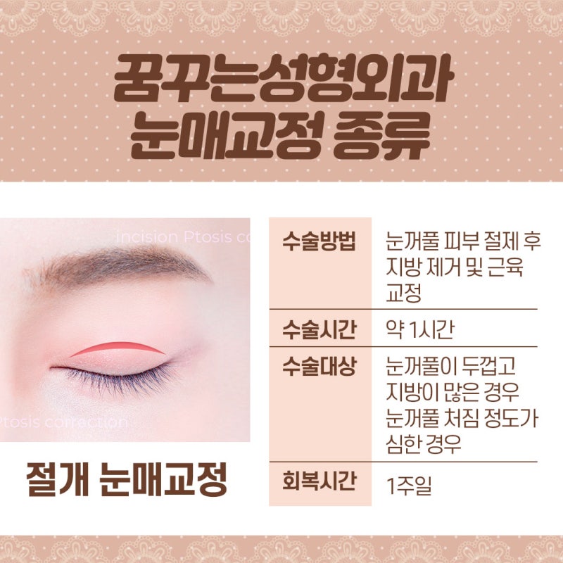 [강남 눈성형] 시원하고 또렷한 눈매교정! 사진 4