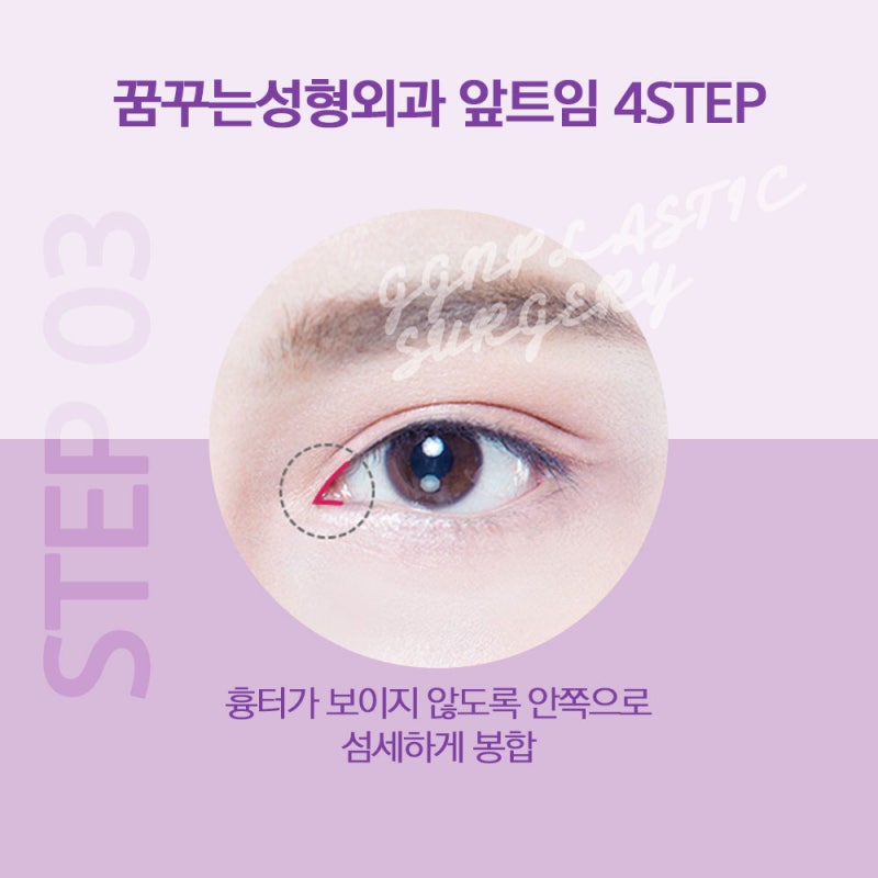 [강남 눈성형] 트임성형은 어떻게 진행될까요? 사진 6