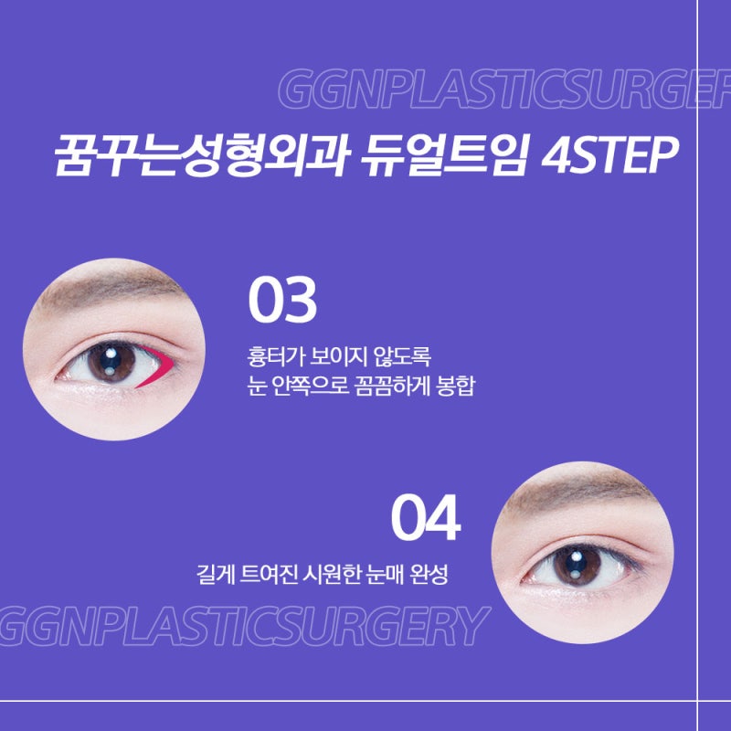 [강남 눈성형] 듀얼 트임을 아시나요? 사진 6