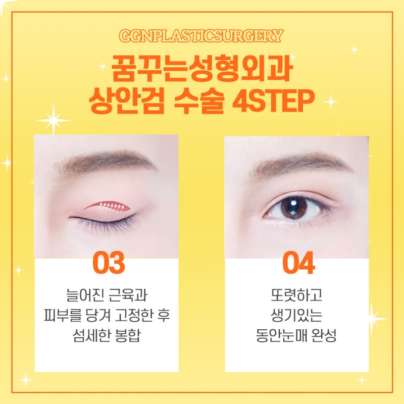 [강남 눈성형] 상안검수술 추천 병원! 사진 4