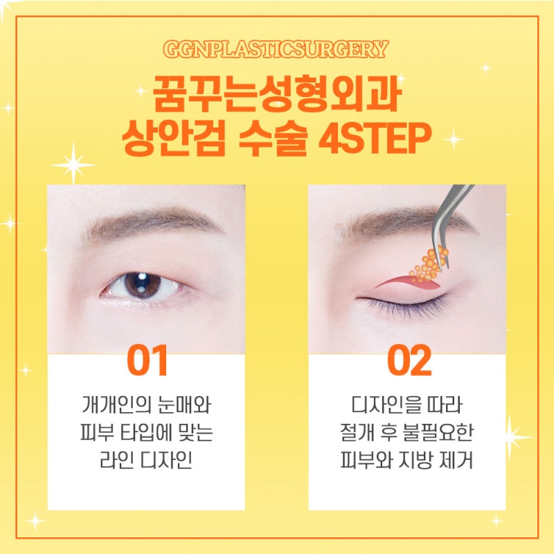 [강남 눈성형] 상안검수술 추천 병원!