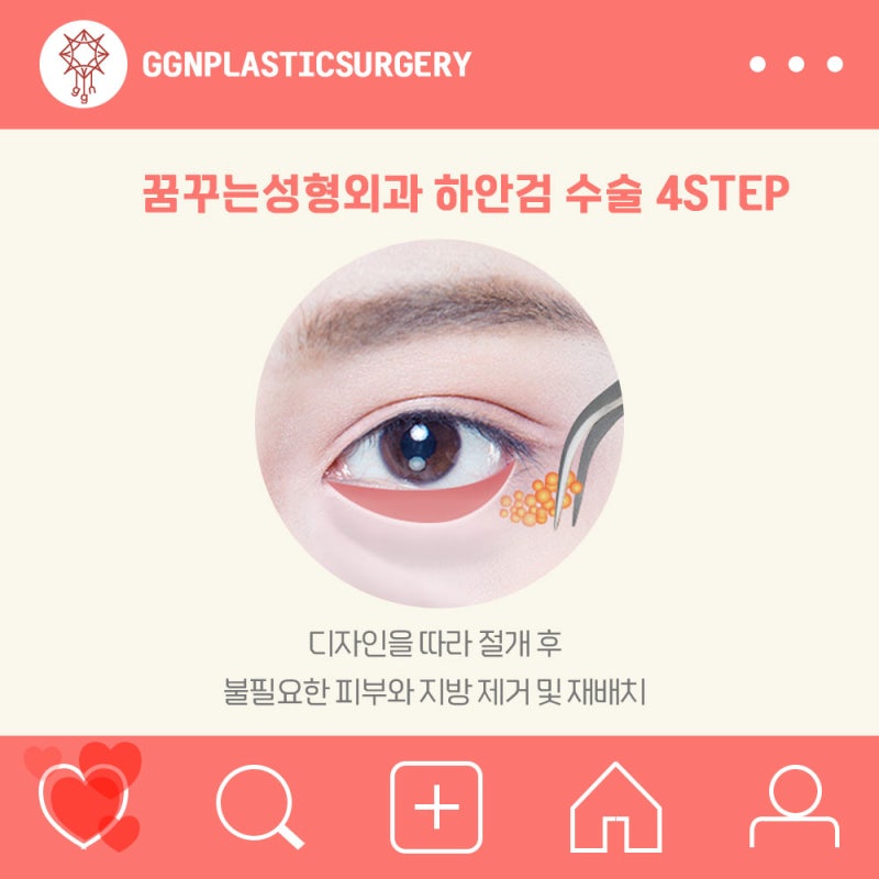 [강남 눈성형] 하안검 수술 잘하는 곳?! 사진 4