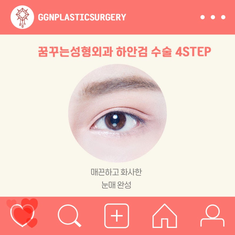[강남 눈성형] 하안검 수술 잘하는 곳?! 사진 6