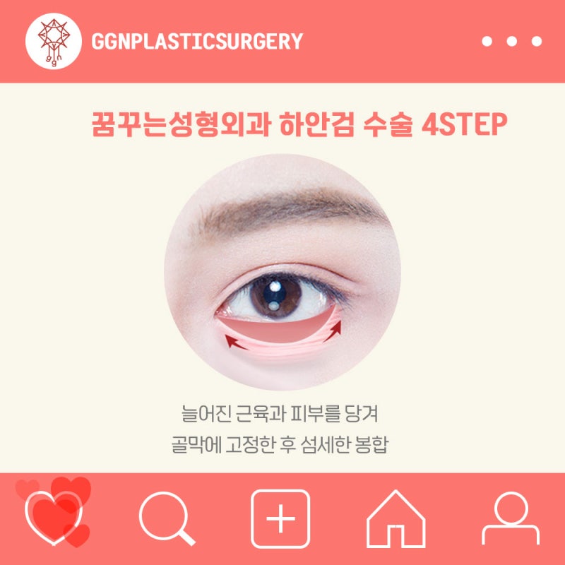 [강남 눈성형] 하안검 수술 잘하는 곳?! 사진 5
