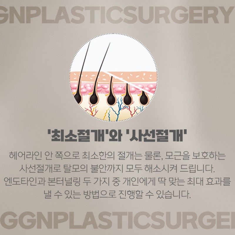 [강남 리프팅] 이마 주름개선엔 하이업 이마리프팅! 사진 5
