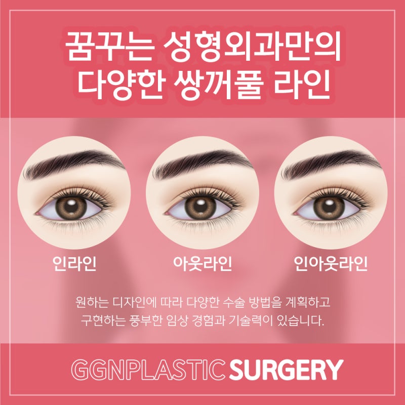 [강남 꿈꾸는성형외과] 예쁜 쌍꺼풀 모양과 조화로운 얼굴