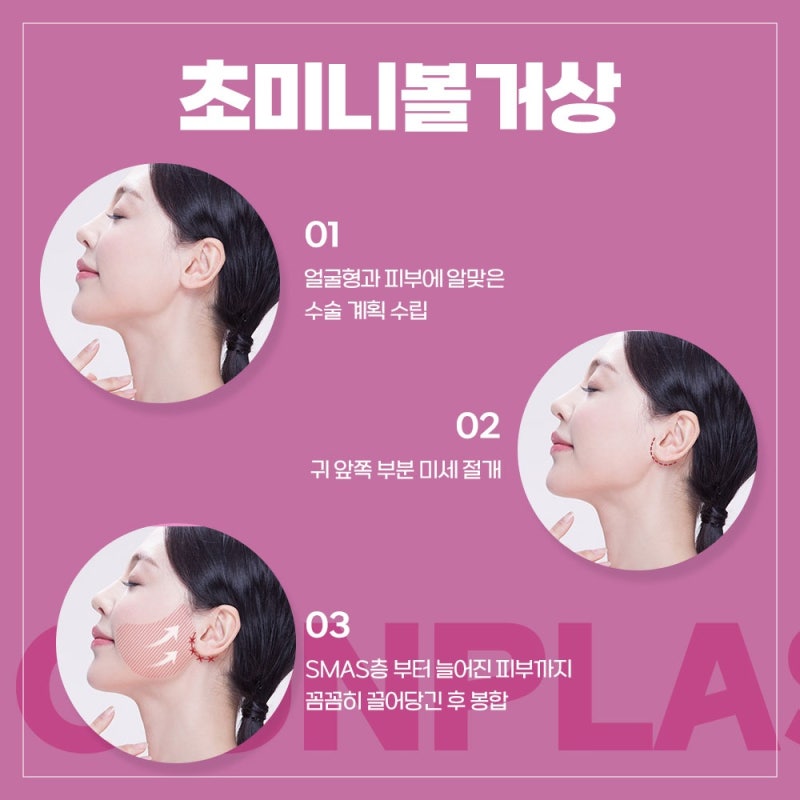[강남 꿈꾸는성형외과] 내 얼굴의 탄력을 위해 리프팅! 사진 6