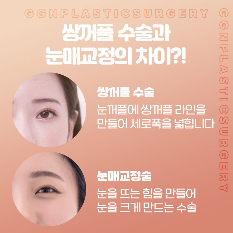 [강남 눈성형]쌍커풀과 눈매교정 어떤걸 해야할까?