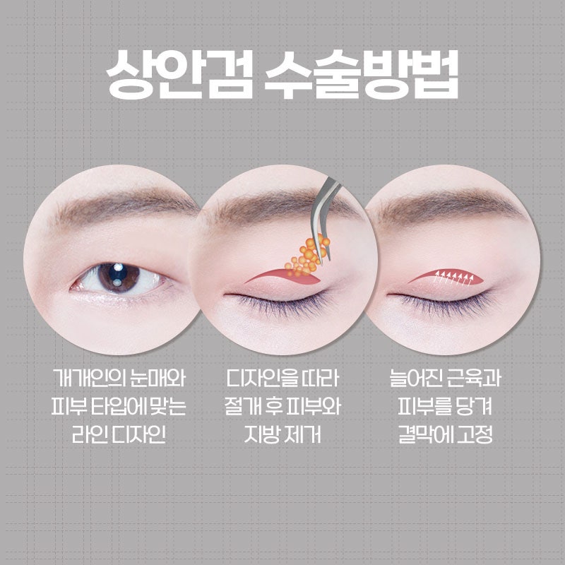 [강남 눈성형] 다시 동안으로 돌아가는 중년눈수술 사진 4
