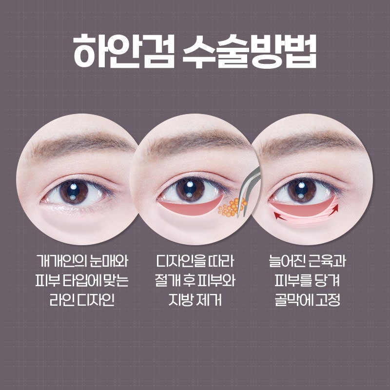 [강남 눈성형] 다시 동안으로 돌아가는 중년눈수술 사진 5