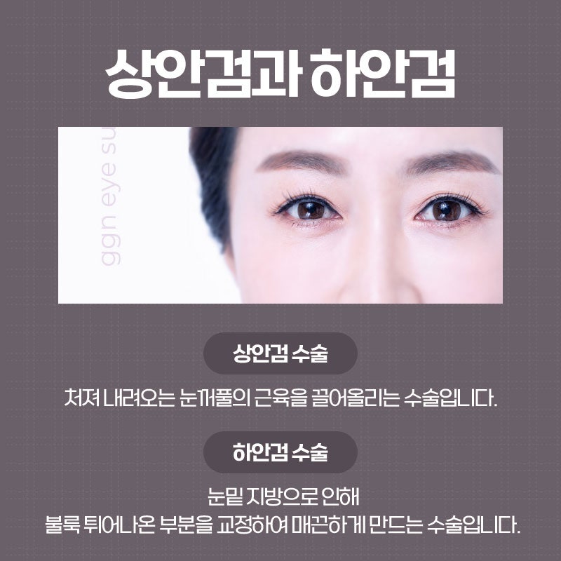 [강남 눈성형] 다시 동안으로 돌아가는 중년눈수술 사진 3