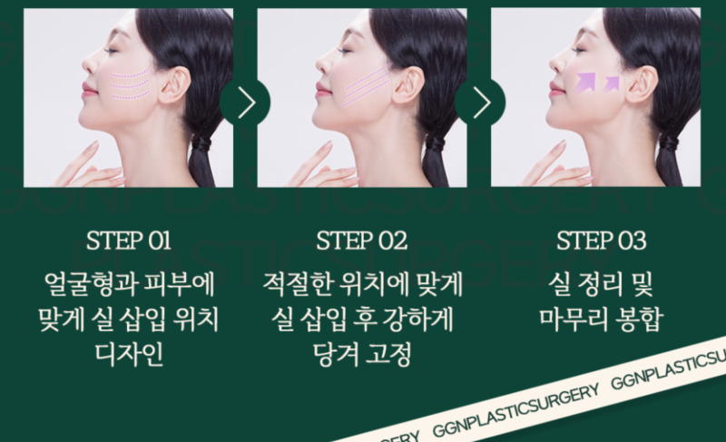 [강남 꿈꾸는 성형외과] 처진 곳을 당겨올리는 '실리프팅' 사진 2