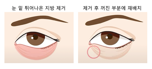 [강남 꿈꾸는 성형외과] 눈 밑 지방 재배치 수술을 하면 안되는 눈이 있을까? 사진 3