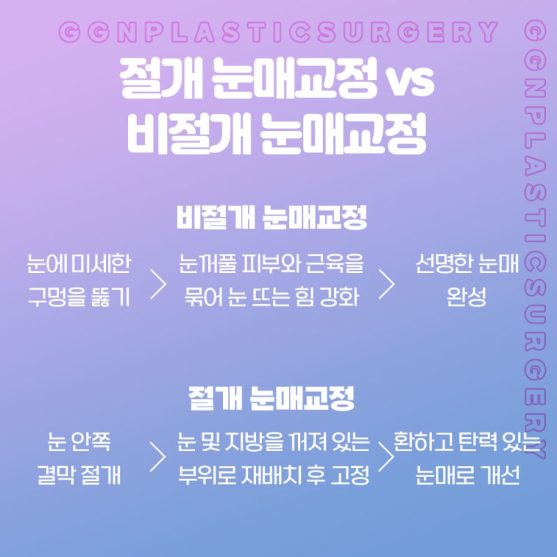[강남 눈성형] 선명하고 확실한 쌍꺼풀&생기로 가득한 반짝이는 눈매교정 사진 5