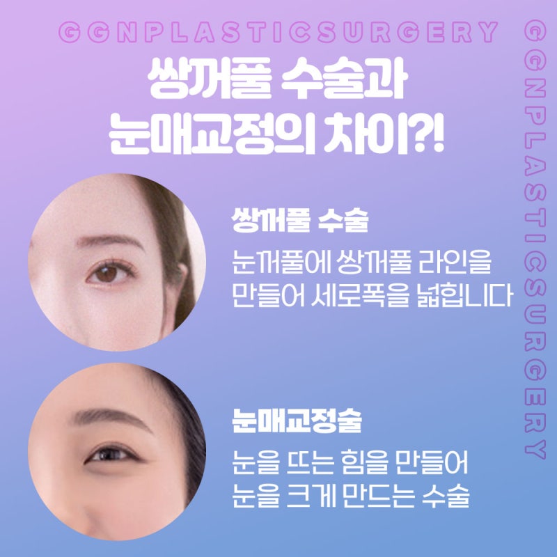 [강남 눈성형] 선명하고 확실한 쌍꺼풀&생기로 가득한 반짝이는 눈매교정