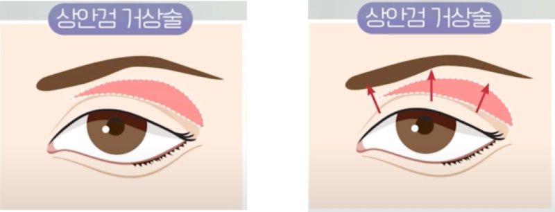 [강남 꿈꾸는 성형외과] 눈꺼풀 리프팅(상안검 거상술) 간단하게 알아보기! 사진 2