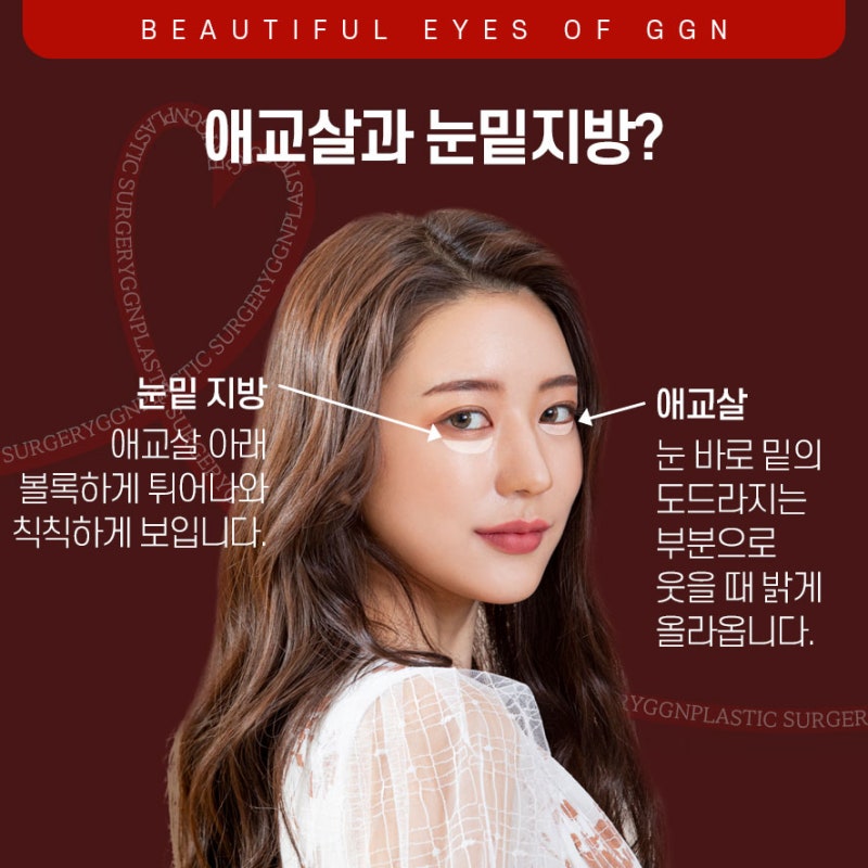 [강남 눈성형] 칙칙한 다크서클 고민엔 눈밑지방재배치 사진 3