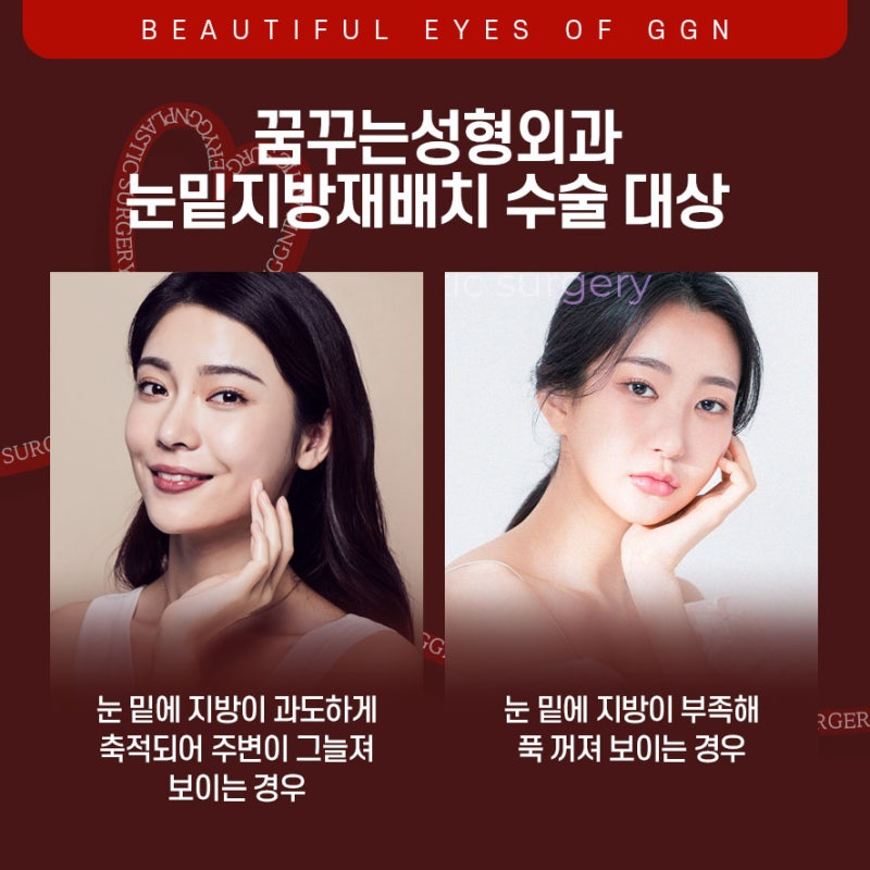 [강남 눈성형] 칙칙한 다크서클 고민엔 눈밑지방재배치 사진 4