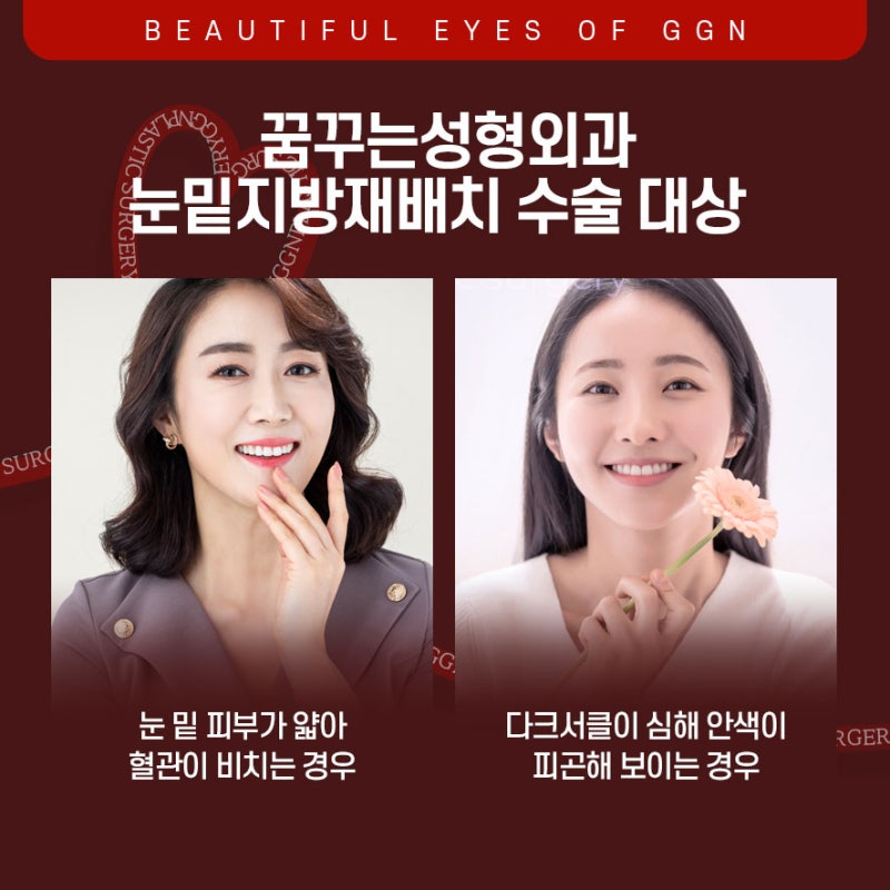 [강남 눈성형] 칙칙한 다크서클 고민엔 눈밑지방재배치 사진 5