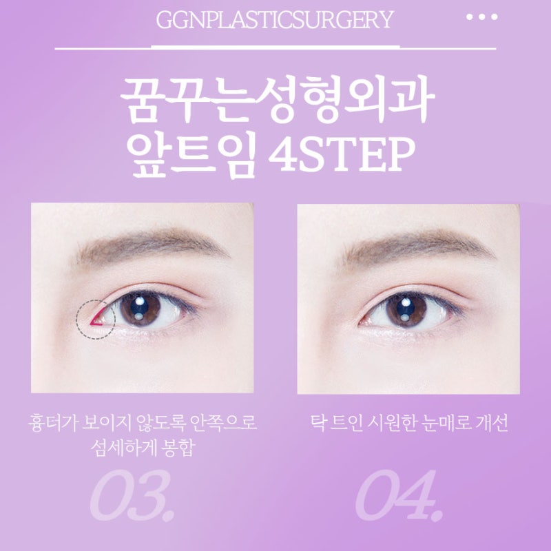 [강남 눈성형] 크고 시원한 눈매를 만들어주는 앞트임! 사진 5