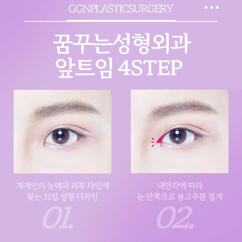[강남 눈성형] 꿈꾸는 성형외과의 수험생을 위한 앞트임 EVENT!!!!(11월 18일~12월 17일) 사진 4