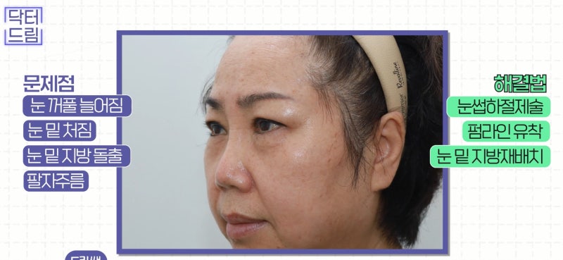 [강남 꿈꾸는 성형외과] 60대 부부, 성형 수술로 새로운 인생 시작! 사진 8