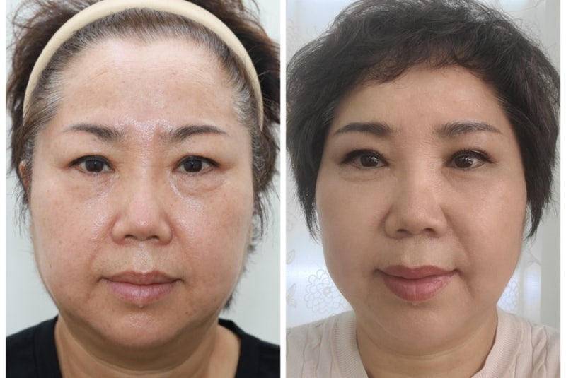 [강남 꿈꾸는 성형외과] 60대 부부, 성형 수술로 새로운 인생 시작! 사진 12