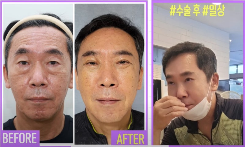 [강남 꿈꾸는 성형외과] 60대 부부, 성형 수술로 새로운 인생 시작! 사진 13