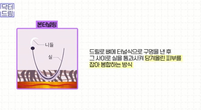 [강남 꿈꾸는 성형외과] 나에게 맞는 이마 거상 수술 방법 찾기!(엔도타인 vs 본터널링) 사진 8