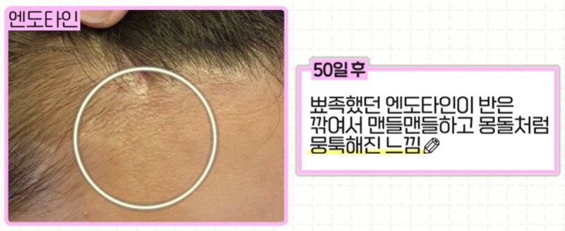 [강남 꿈꾸는 성형외과] 나에게 맞는 이마 거상 수술 방법 찾기!(엔도타인 vs 본터널링) 사진 15