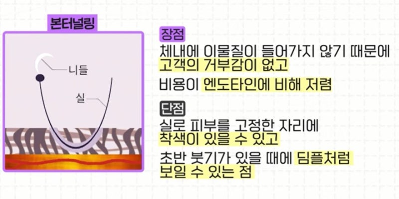 [강남 꿈꾸는 성형외과] 나에게 맞는 이마 거상 수술 방법 찾기!(엔도타인 vs 본터널링) 사진 9