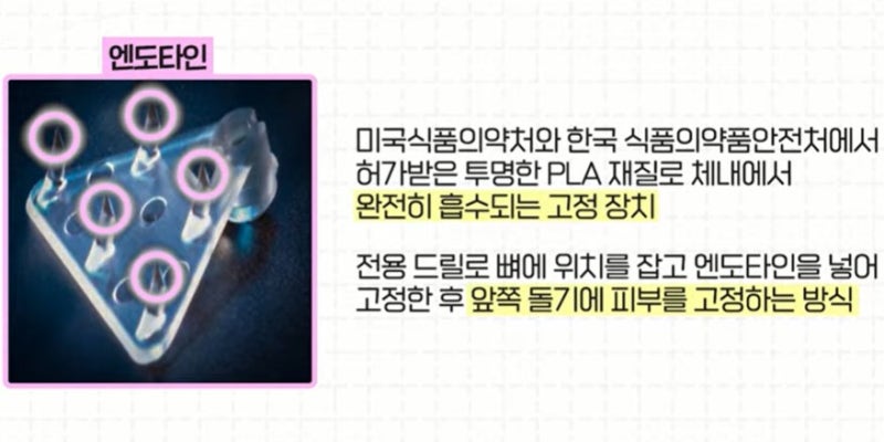 [강남 꿈꾸는 성형외과] 나에게 맞는 이마 거상 수술 방법 찾기!(엔도타인 vs 본터널링) 사진 5