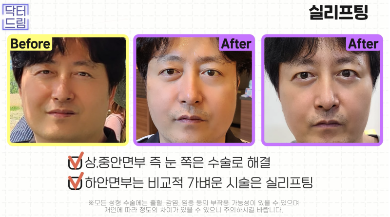 [강남 꿈꾸는 성형외과] 동안 되는 중년 성형 TOP3!! 사진 16