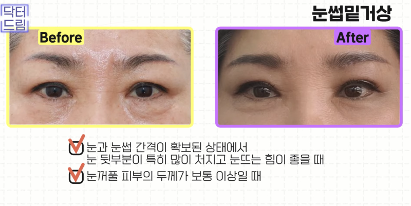 [강남 꿈꾸는 성형외과] 동안 되는 중년 성형 TOP3!! 사진 8