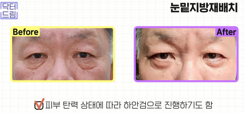 [강남 꿈꾸는 성형외과] 동안 되는 중년 성형 TOP3!! 사진 12