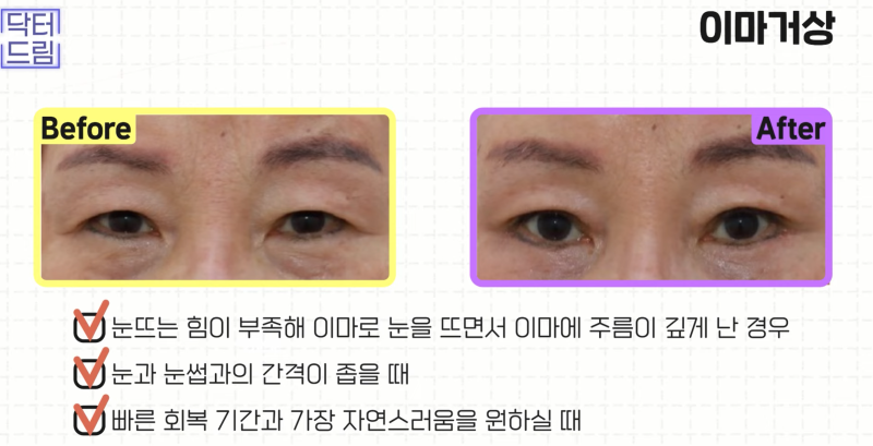 [강남 꿈꾸는 성형외과] 동안 되는 중년 성형 TOP3!! 사진 9