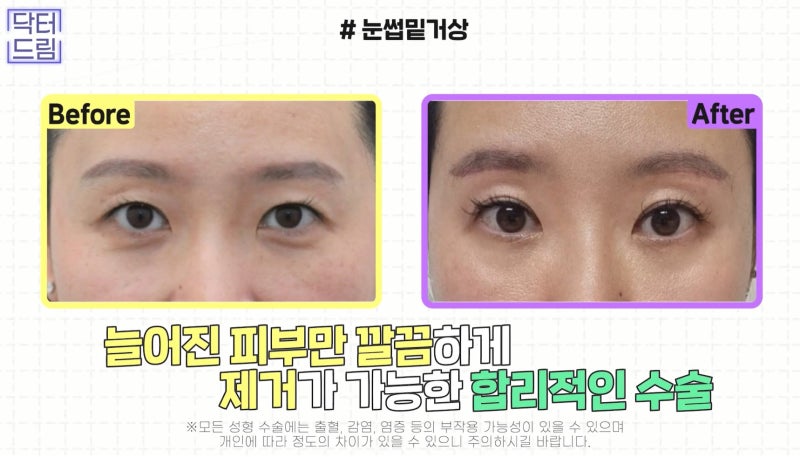 [강남 꿈꾸는 성형외과] 내 눈에 딱 맞는 눈 수술(자가진단법!) 사진 9