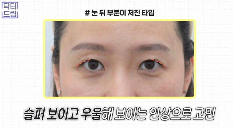 [강남 꿈꾸는 성형외과] 내 눈에 딱 맞는 눈 수술(자가진단법!) 사진 6