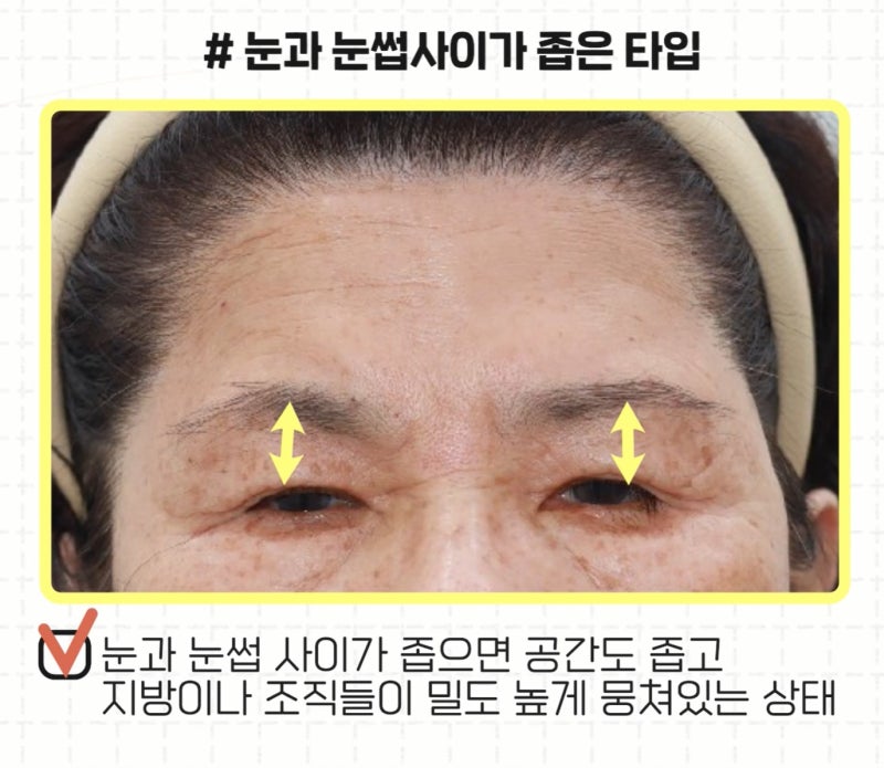 [강남 꿈꾸는 성형외과] 내 눈에 딱 맞는 눈 수술(자가진단법!) 사진 4