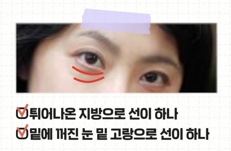 [강남 꿈꾸는 성형외과] 내 눈에 딱 맞는 눈 밑 지방제거! 사진 4