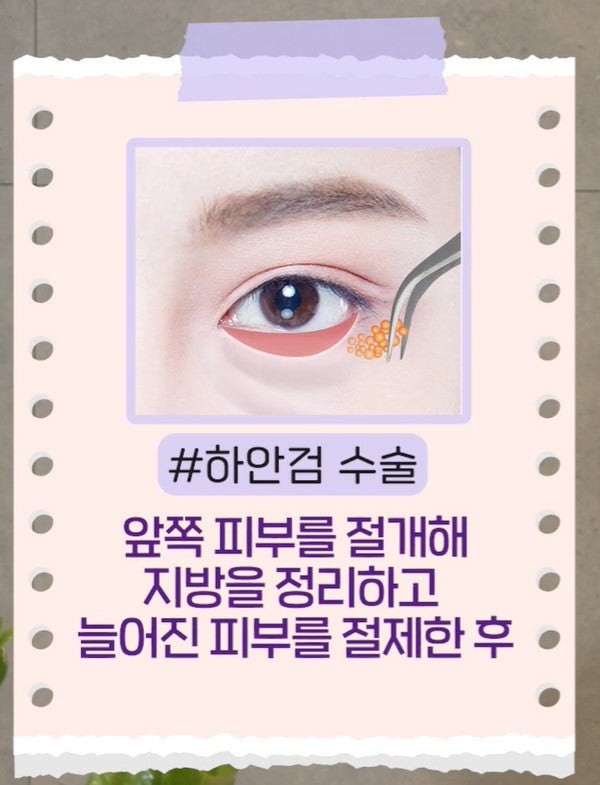 [강남 꿈꾸는 성형외과] 내 눈에 딱 맞는 눈 밑 지방제거! 사진 12