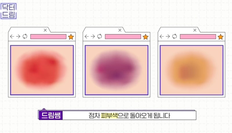 [강남꿈꾸는성형외과] 성형수술을 준비/진행하는 분들 주목! 성형 수술 후 주의사항! 사진 22