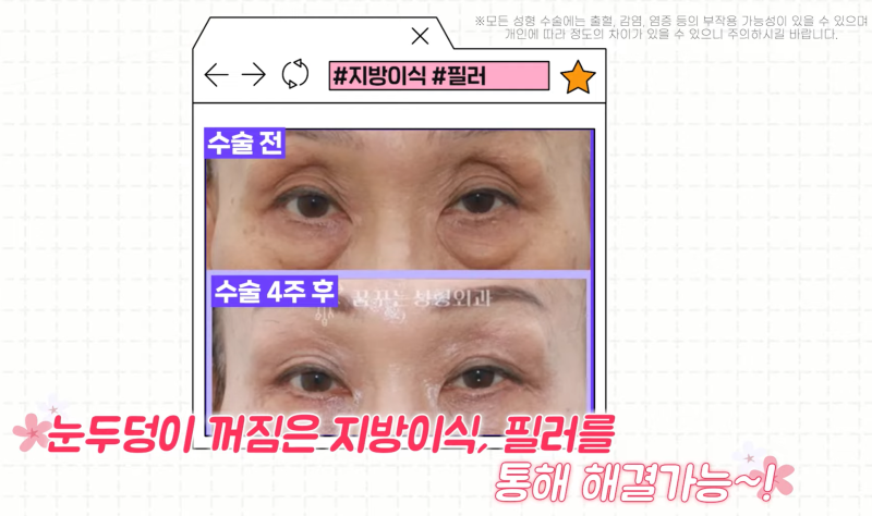 [강남 꿈꾸는성형외과] 족집게 과외 / 나에게 맞는 안티에이징 찾아드림!! 사진 17