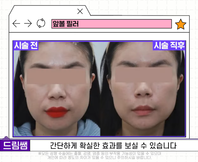 [강남 꿈꾸는성형외과] 족집게 과외 / 나에게 맞는 안티에이징 찾아드림!! 사진 21