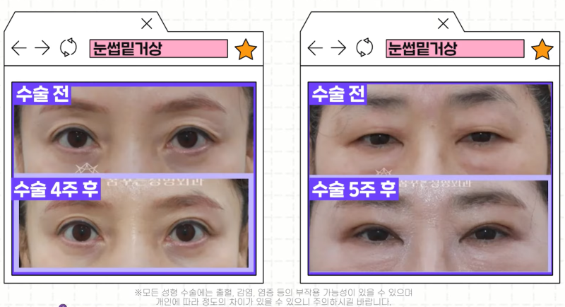 [강남 꿈꾸는성형외과] 족집게 과외 / 나에게 맞는 안티에이징 찾아드림!! 사진 14